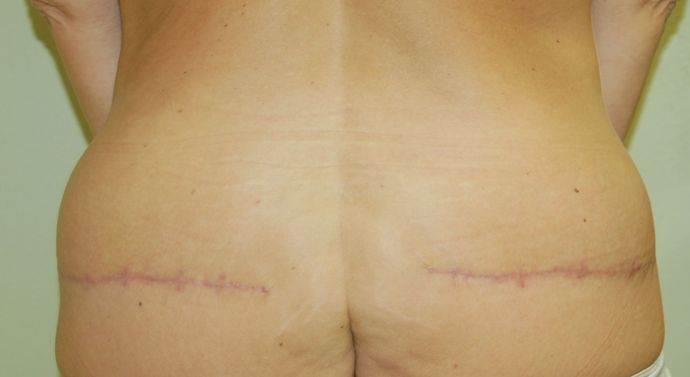 Buttock Lift Case 4 - After