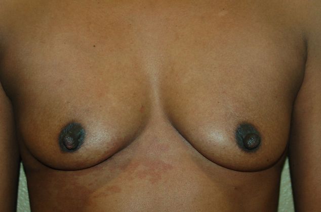 Breast Augmentation Case 338 - Before