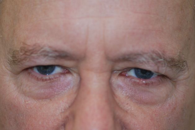 Upper Eyelid Blepharoplasty: 5 - BEFORE