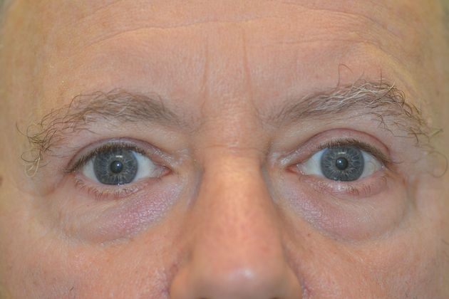 Upper Eyelid Blepharoplasty: 5 - AFTER
