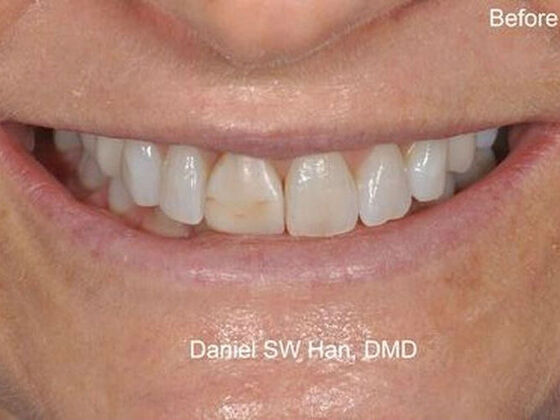 Cosmetic Dentistry: Case 2 - Before Cosmetic makeover