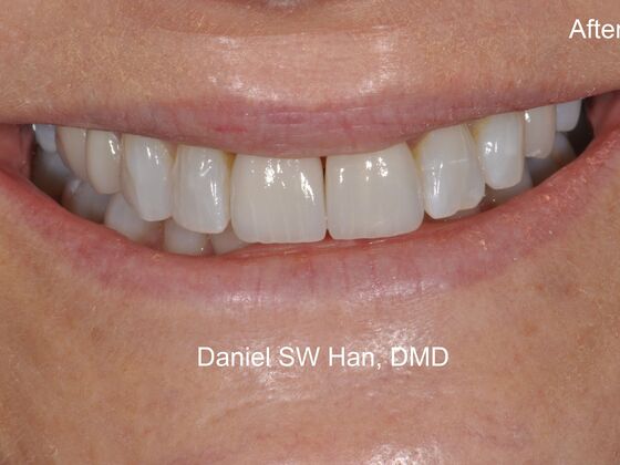 Cosmetic Dentistry: Case 2 - After cosmetic makeover