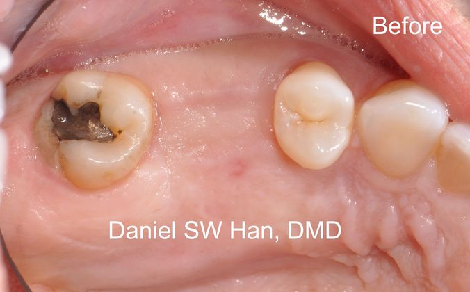 Dental Implants Case 1 - Before
