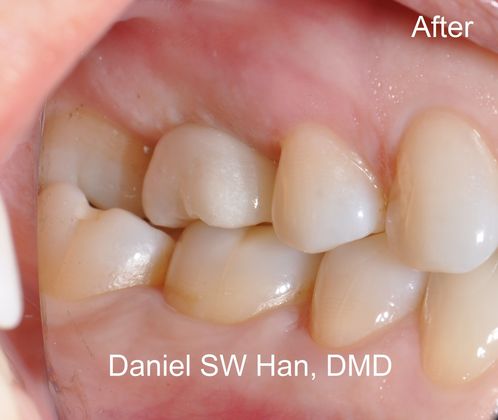 Dental Implants: Case 1 - Abutment supported crown (Second tooth on the upper jaw from the left)