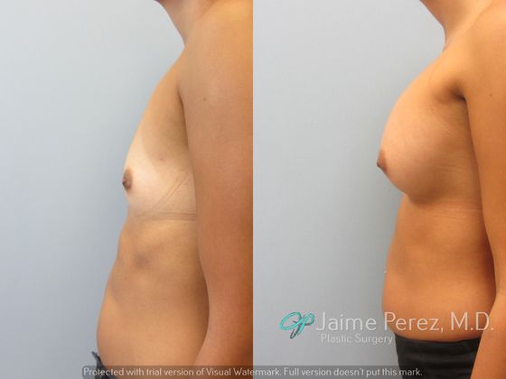 Breast Augmentation: Silicone Breast Enlargement