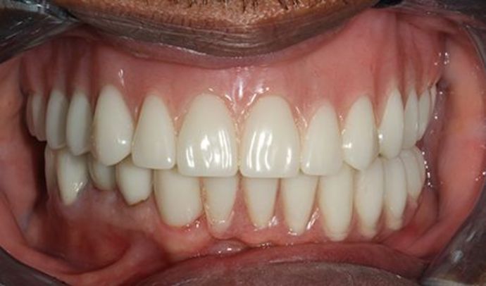Full Mouth Reconstruction Brooklyn NY Cases