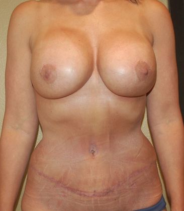 Mommy Makeover Case 65 - After