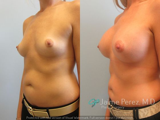 Breast Augmentation: 35 year old Breast Enlargement