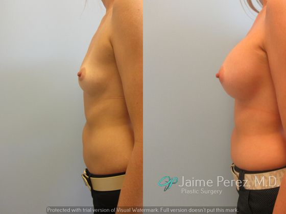 Breast Augmentation: 35 year old Breast Enlargement