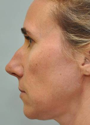 Rhinoplasty: Case 8 - Rhinoplasty, Westport - Before