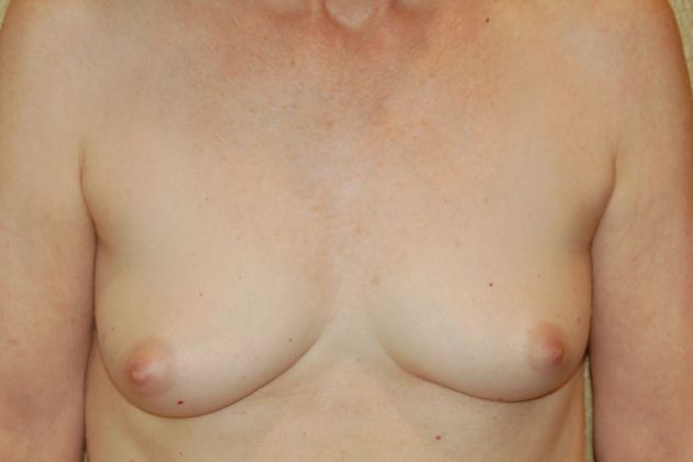 Breast Reconstruction Case 53 - Before