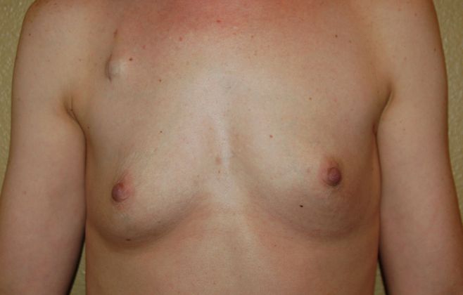 Breast Reconstruction Case 54 - Before