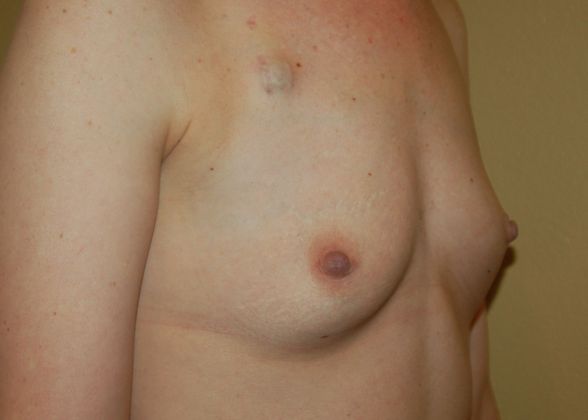 Breast Reconstruction: Case 54 - Before