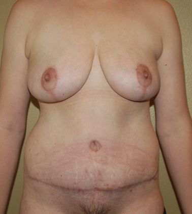 Mommy Makeover Case 66 - After