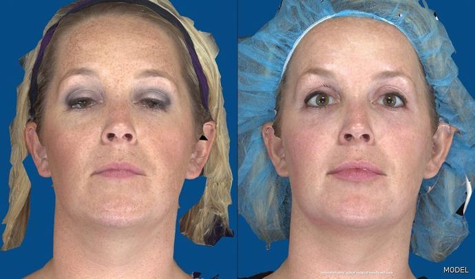 Facial Pigmentation Problems Case
