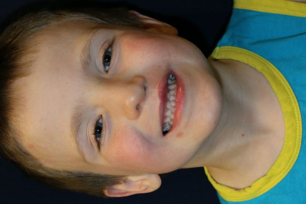 Cleft Lip*: Case 5 - After 5 years