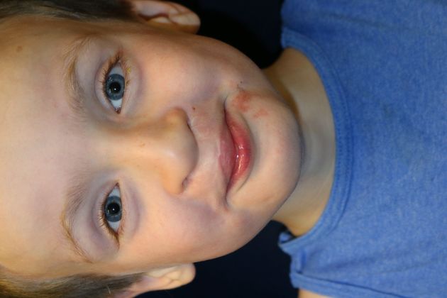 Cleft Lip*: Case 7 - 5 years after 