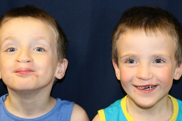 Cleft Lip*: Case 7 - Brothers