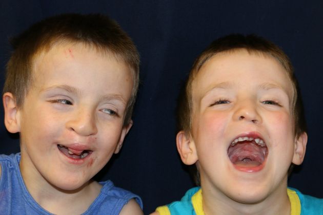 Cleft Lip*: Case 5 - Brothers after cleft lip/palate repair