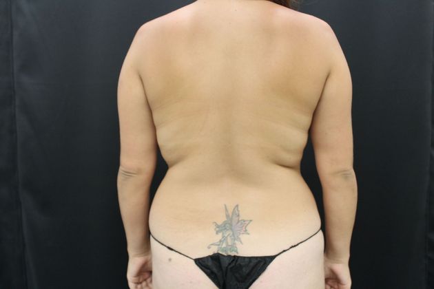 Liposuction Case 8 - Before