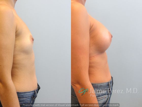 Full Size C Cup Breast Implants Photos - Dr. Piro