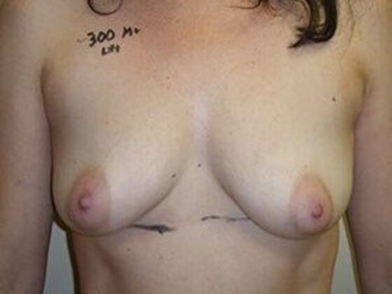 Breast Augmentation: Case 7 - Before