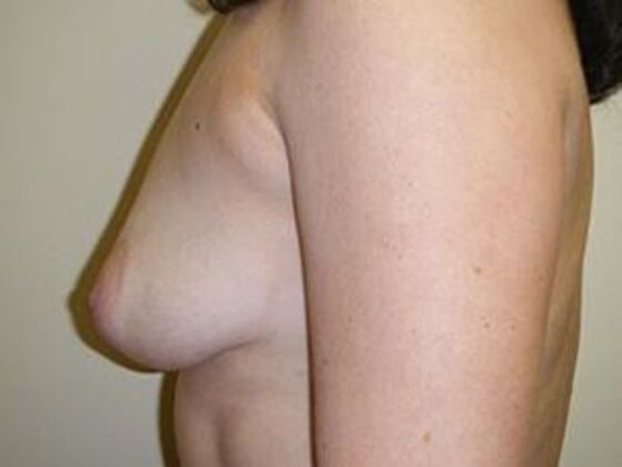 Breast Augmentation: Case 7 - Before
