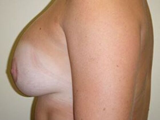 Breast Augmentation: Case 7 - After
