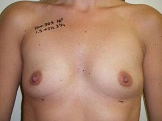 Breast Augmentation: Case 8 - Before