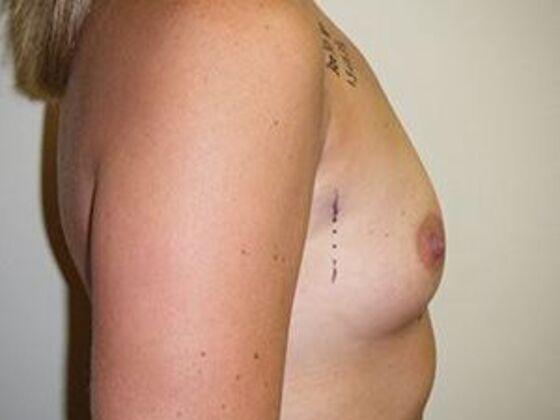 Breast Augmentation: Case 8 - Before