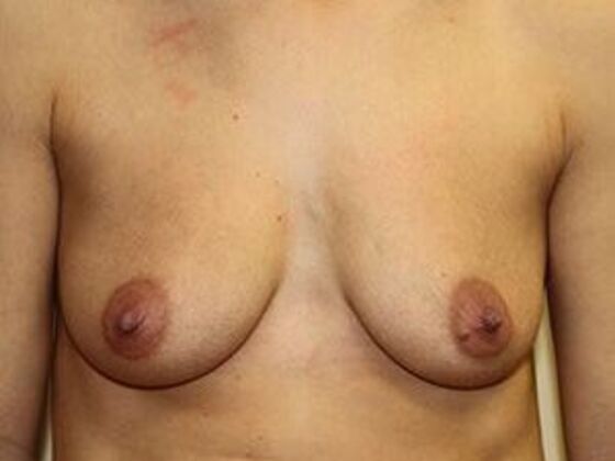 Breast Augmentation: Case 9 - Before