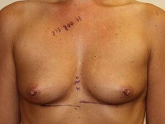 Breast Augmentation: Case 10 - Before