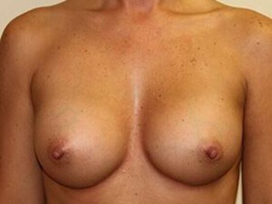 Breast Augmentation: Case 10 - After