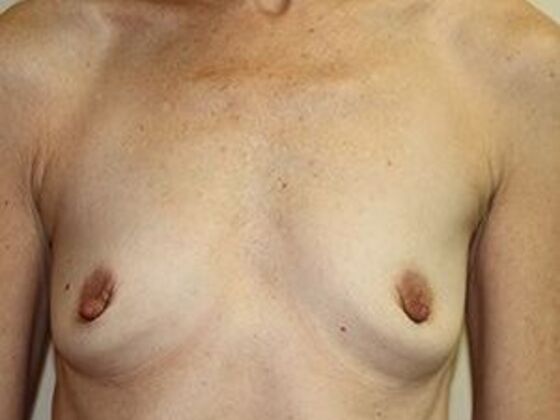 Breast Augmentation: Case 1 - Before