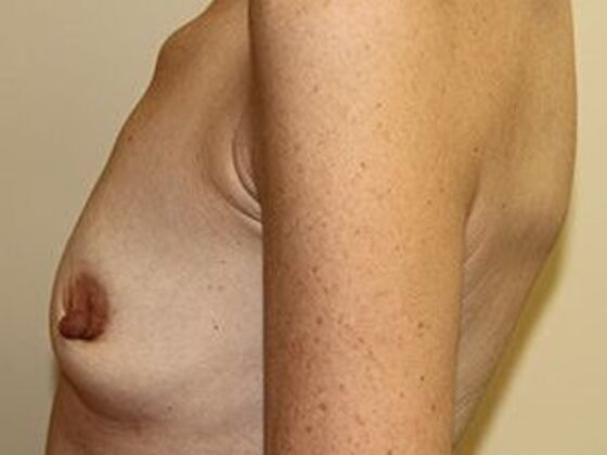 Breast Augmentation: Case 1 - Before