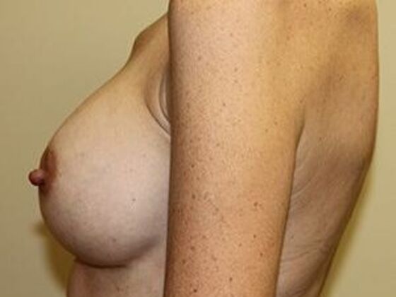 Breast Augmentation: Case 1 - After