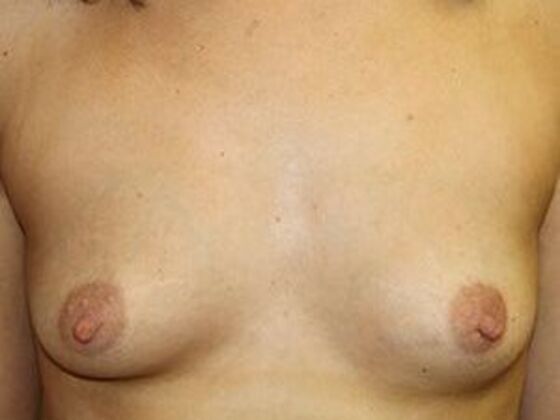 Breast Augmentation: Case 2 - Before