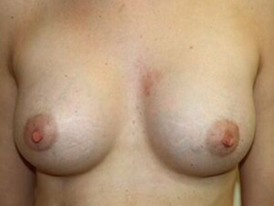 Breast Augmentation: Case 2 - After