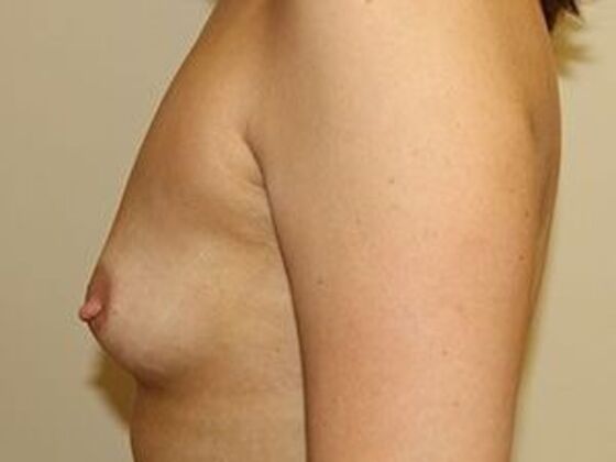 Breast Augmentation: Case 2 - Before