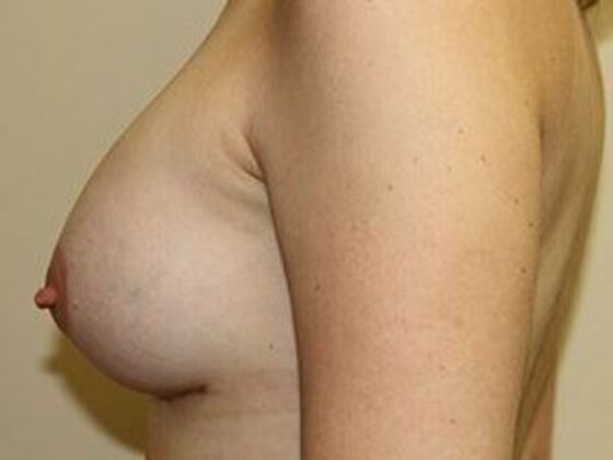 Breast Augmentation: Case 2 - After