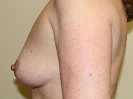 Breast Augmentation: Case 3 - Before
