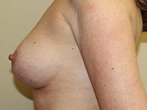 Breast Augmentation: Case 3 - After