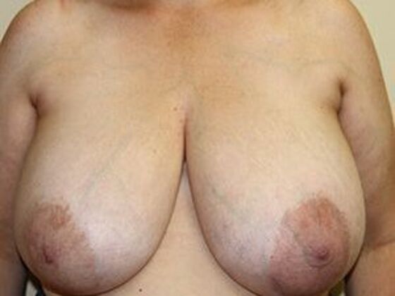 Breast Reduction Case 1 - Before