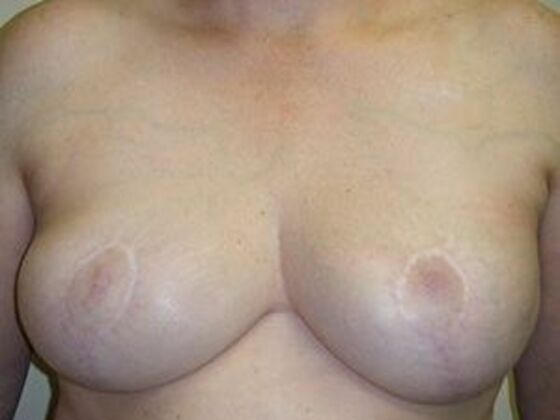 Breast Reduction Case 1 - After