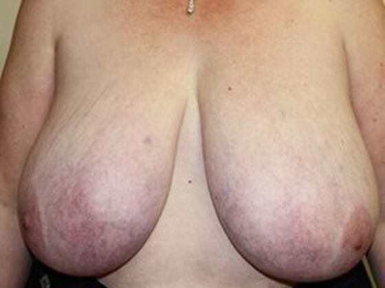 Breast Reduction Case 2 - Before