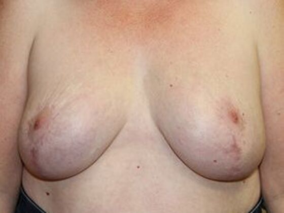 Breast Reduction Case 2 - After
