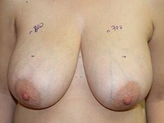 Breast Reduction Case 3 - Before