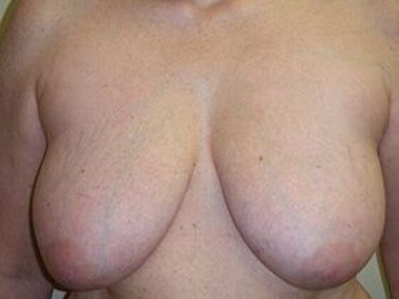 Breast Reduction Case 4 - Before
