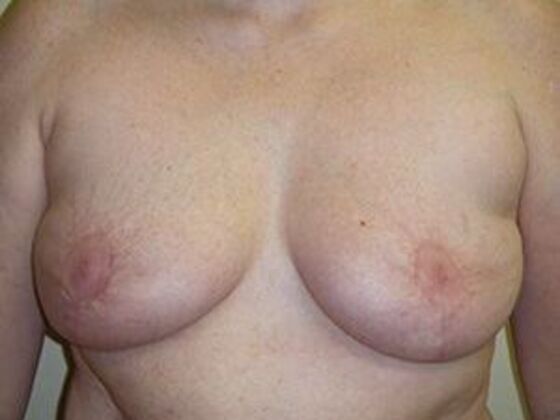 Breast Reduction Case 4 - After