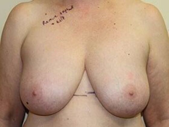 Mastopexy Case 1 - Before
